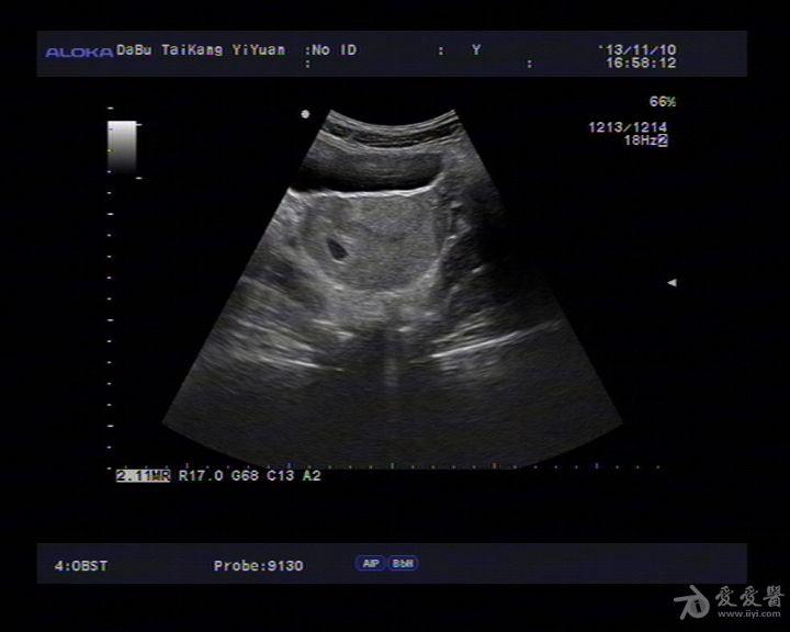 宫角妊娠的超声图像图片