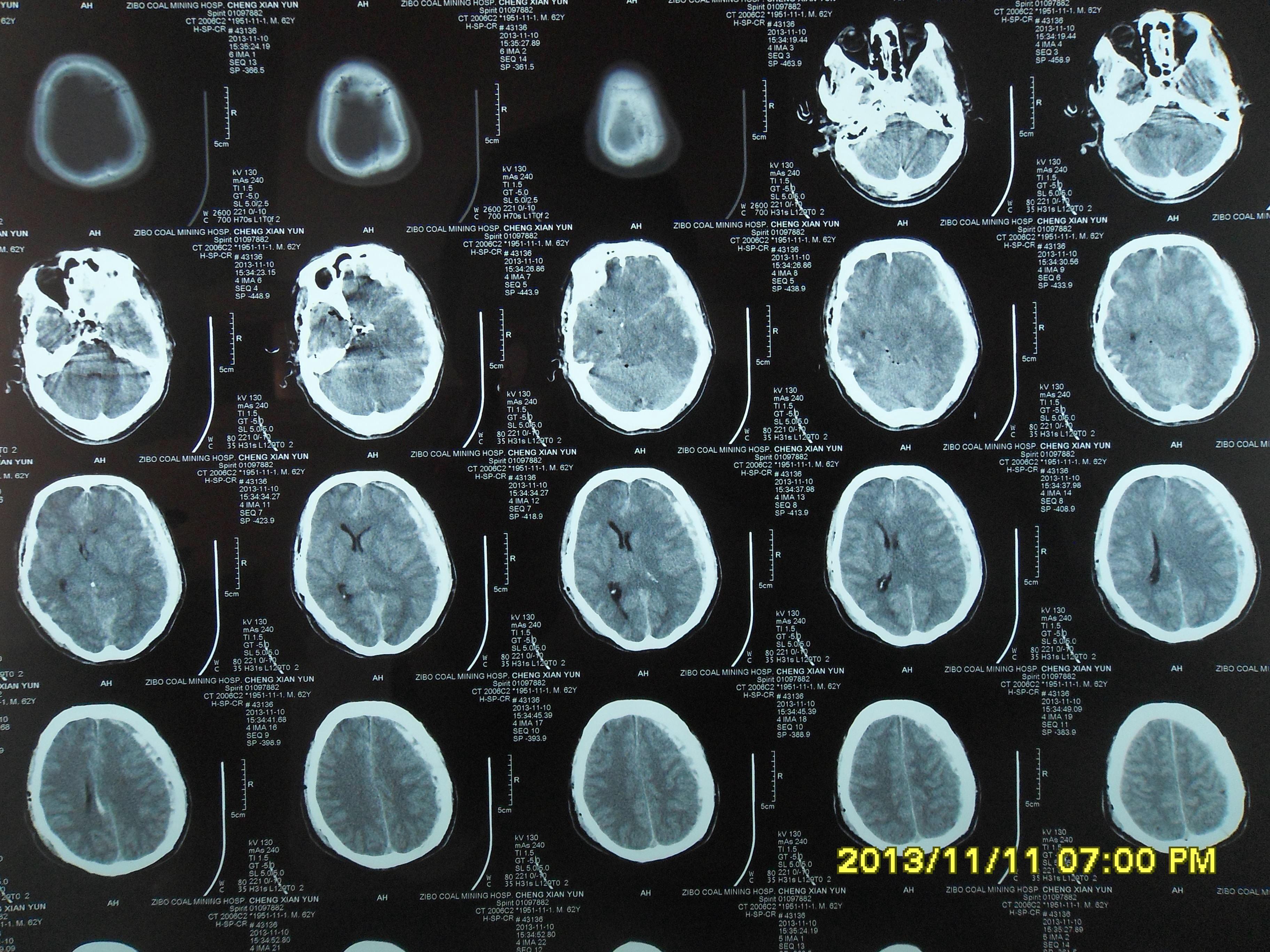 又一例特重型颅脑伤病人