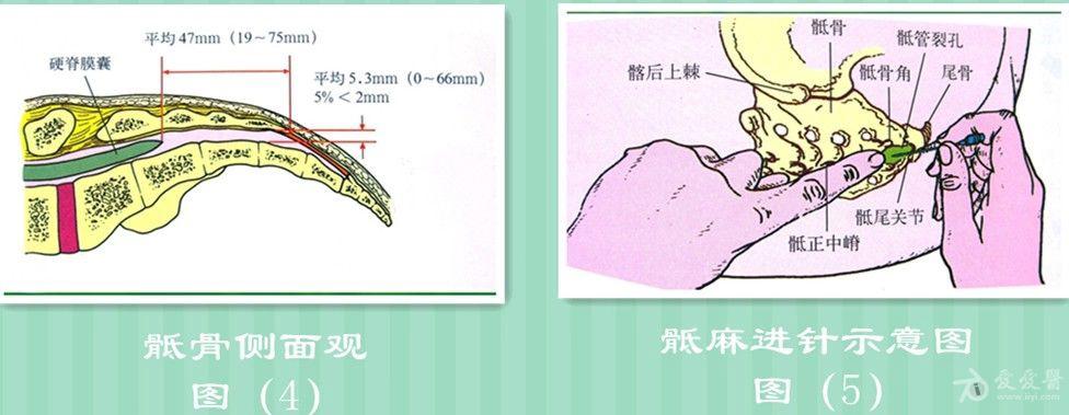 骶管麻醉的标志图片