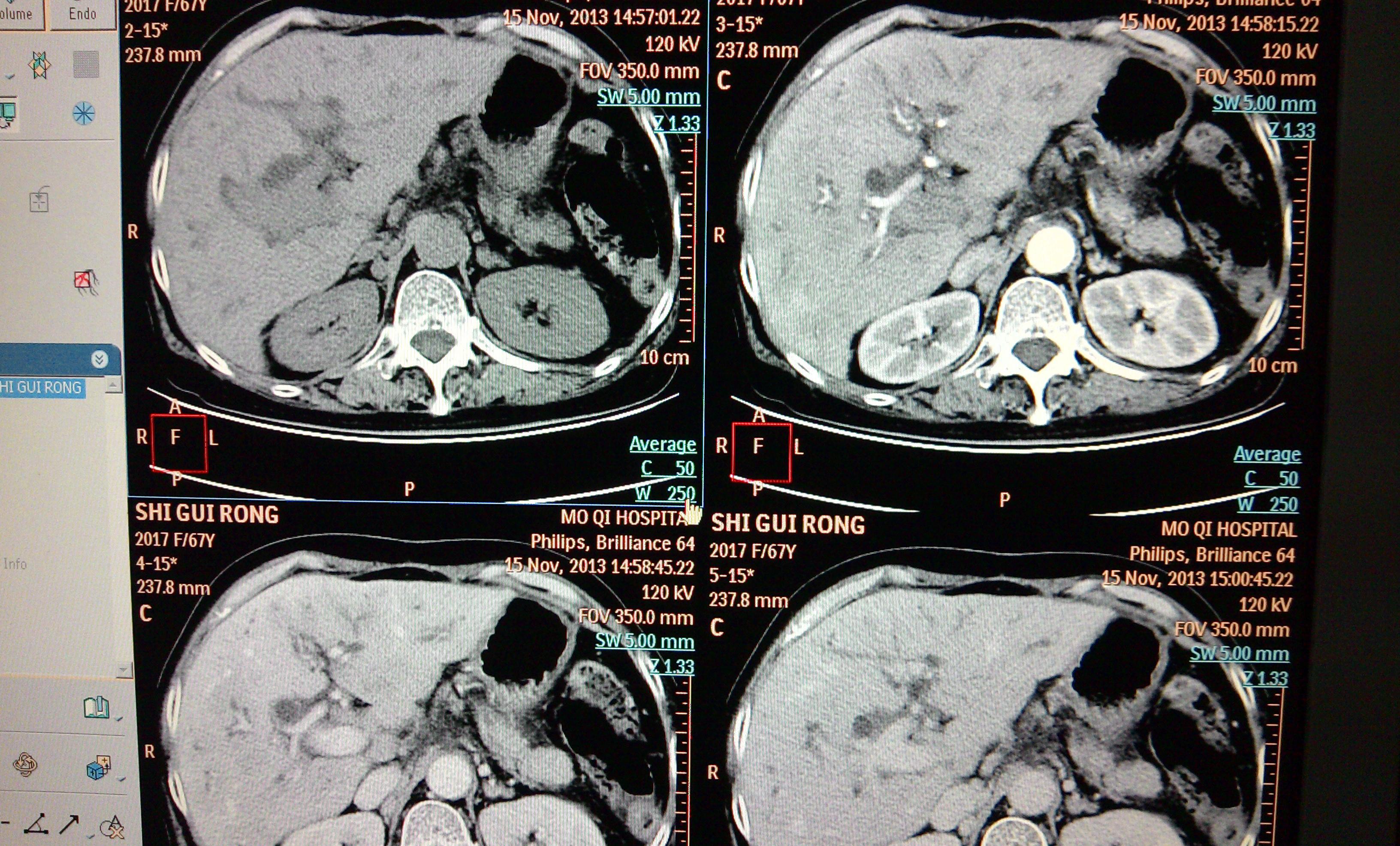 胆总管占位 - 医学影像学讨论版 - 爱爱医医学论坛