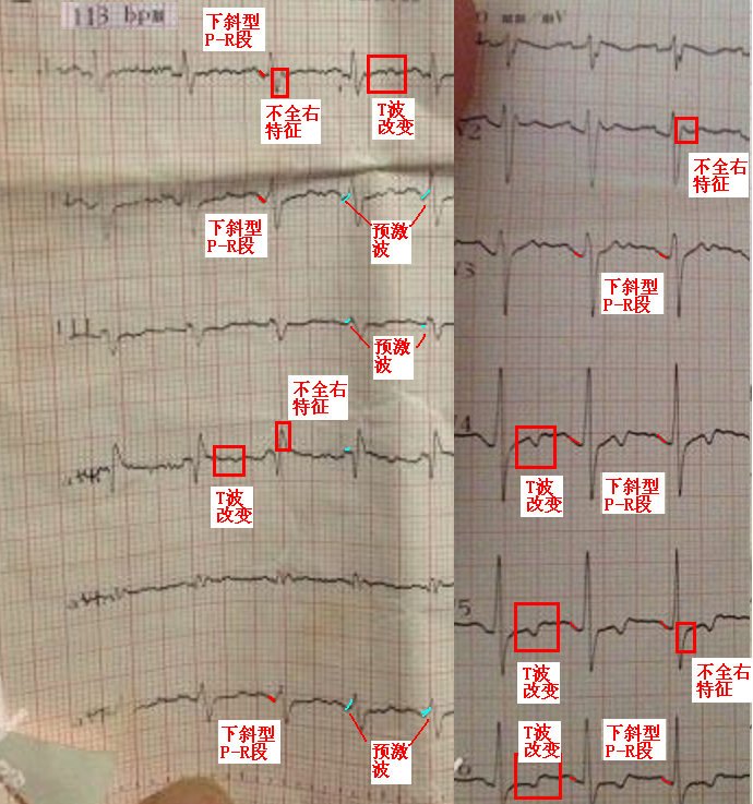 基线是用qrs波的起点做一条延长线就是基线吗? - 心电图脑电图专业讨