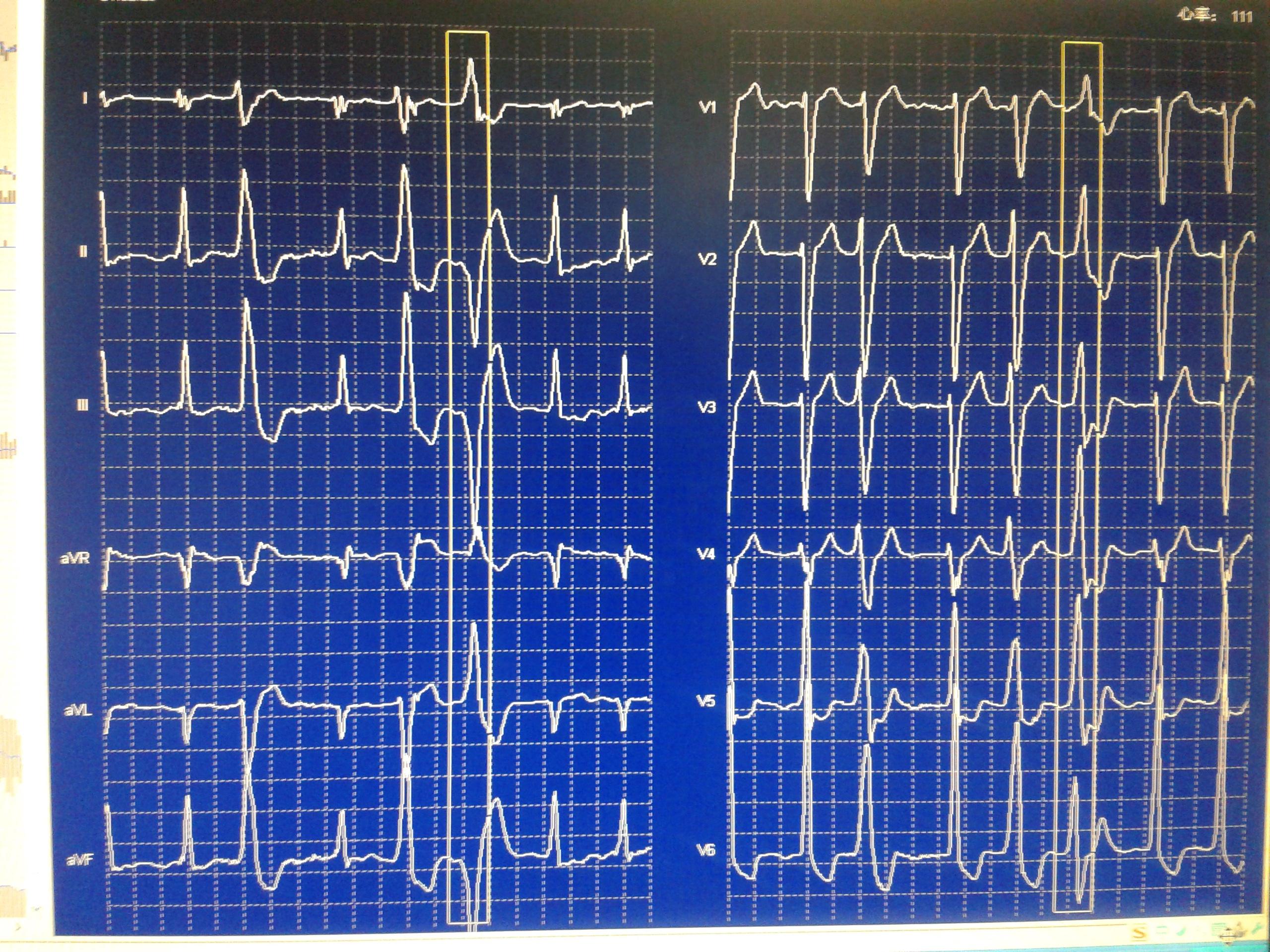 這幅圖是房顫伴差傳還是伴預激還是室速發動態心電圖繼續討論