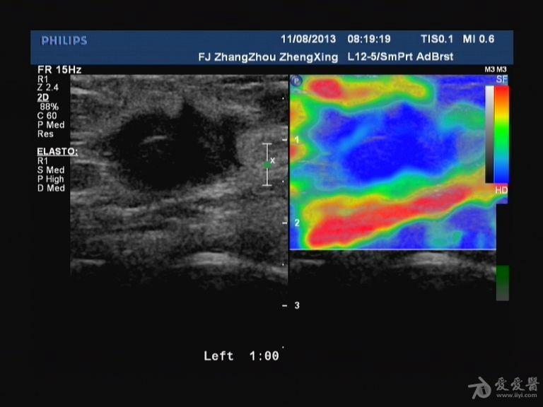 乳腺癌早期彩超图片图片