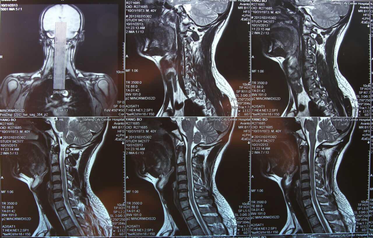 看下我的颈椎核磁片