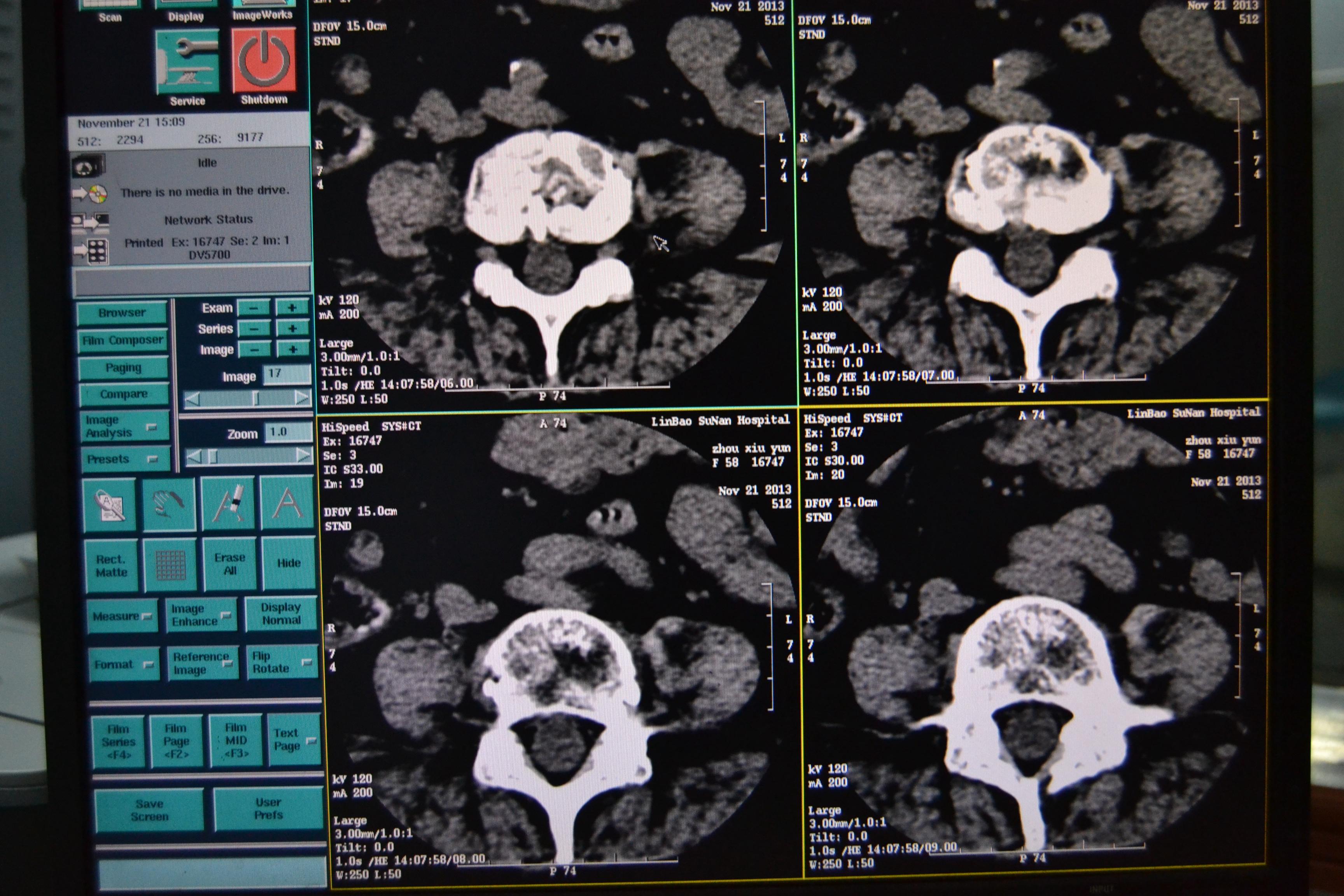 腰椎看看是结核吗