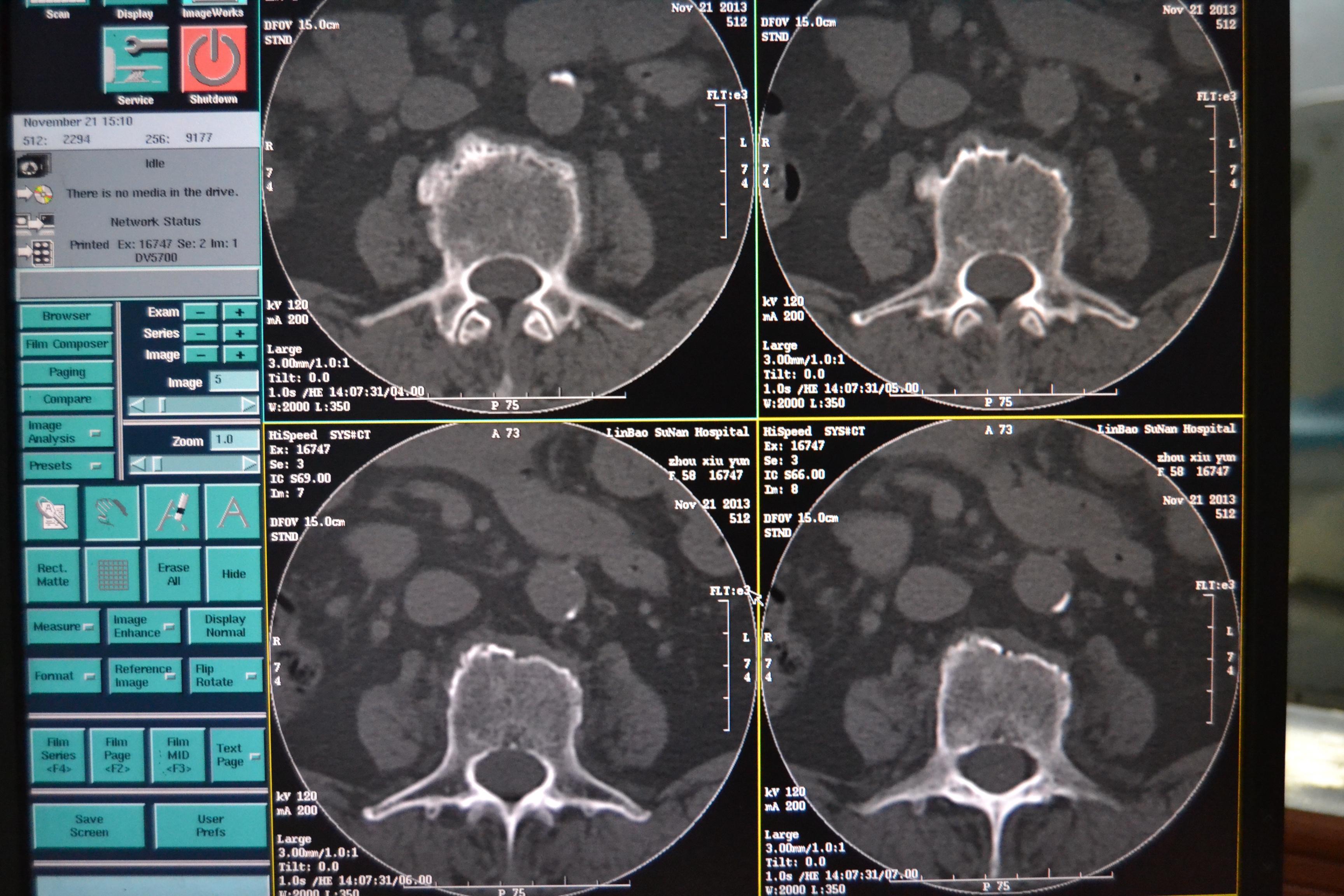 腰椎看看是结核吗