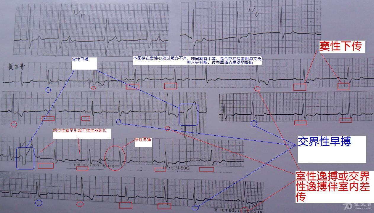 過去單導聯心電圖,斷斷續續,實在是很難分析.