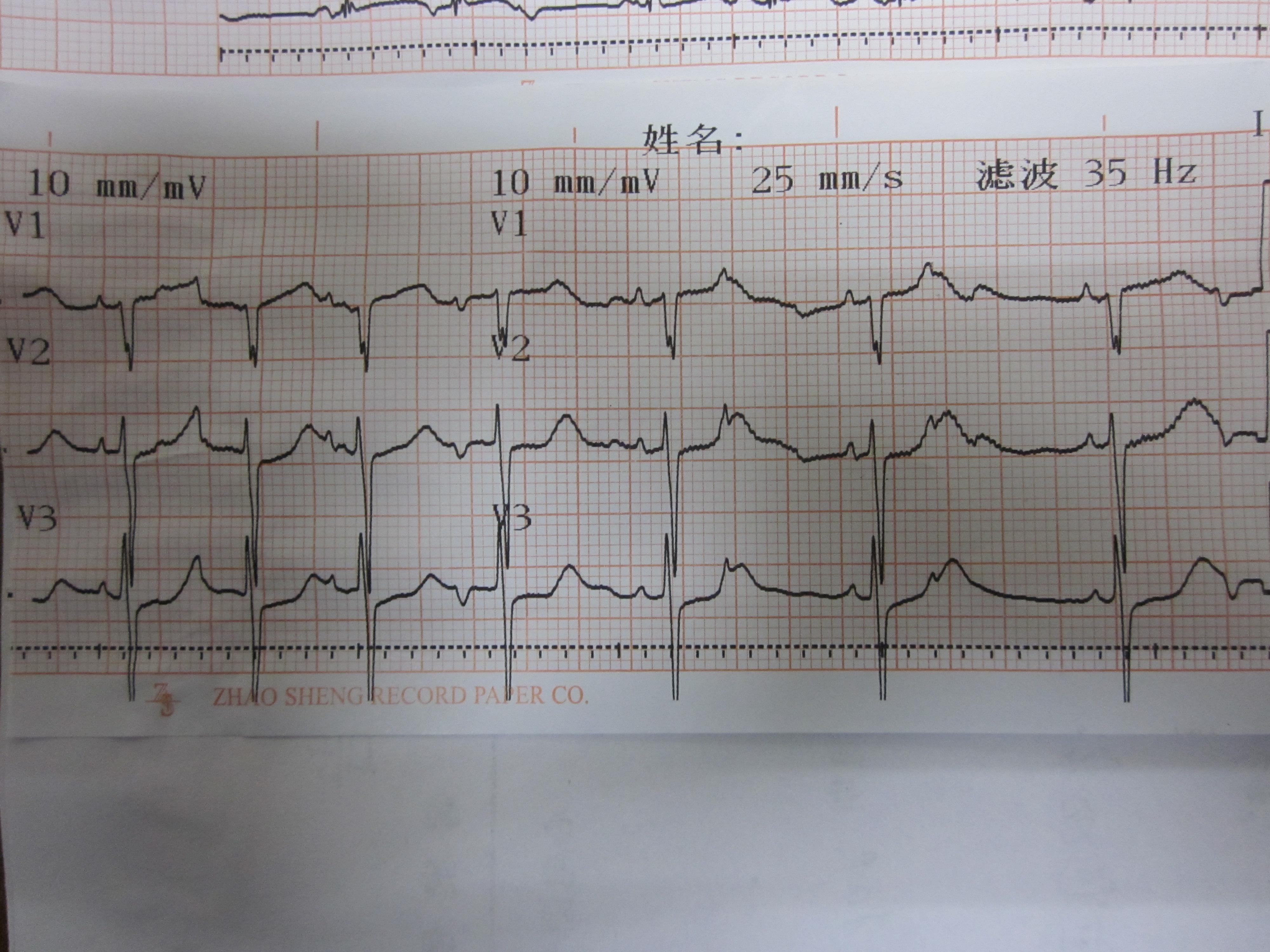 紊乱性房性心动过速伴传出阻滞