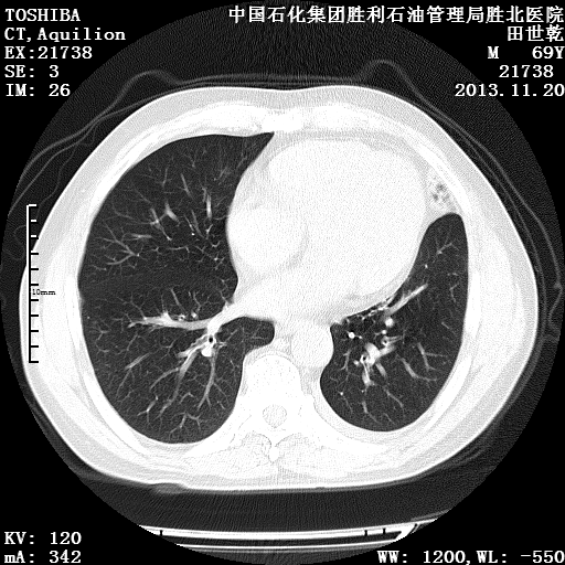 肺窗