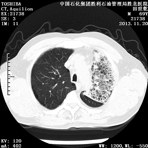 肺窗