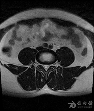 脊髓终丝脂肪瘤.