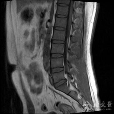 椎管内脂肪瘤图片