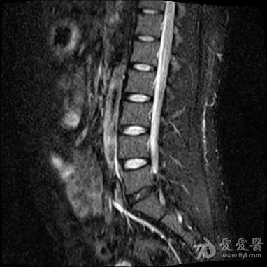 脊髓终丝脂肪瘤.