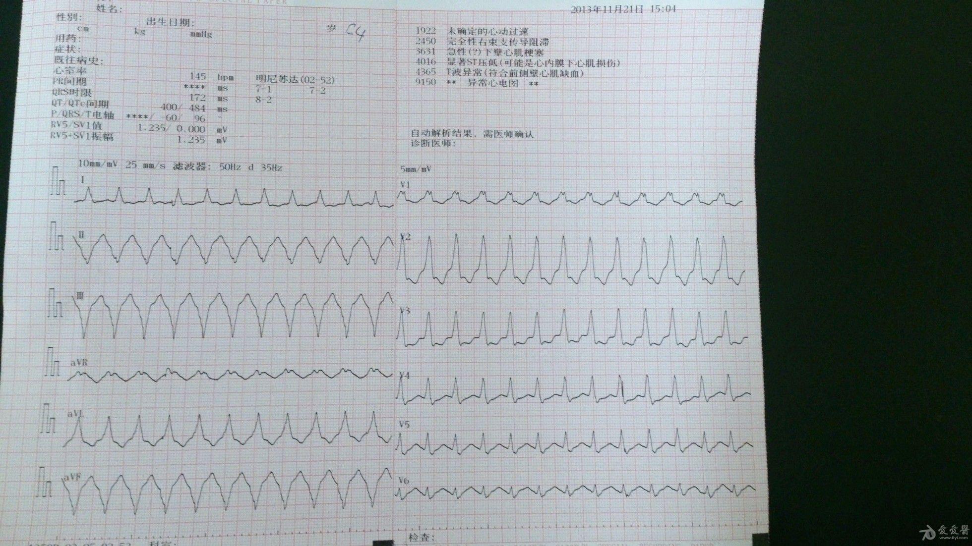 求助,请版主帮忙看下这份图是室速还是室上速伴随差传?