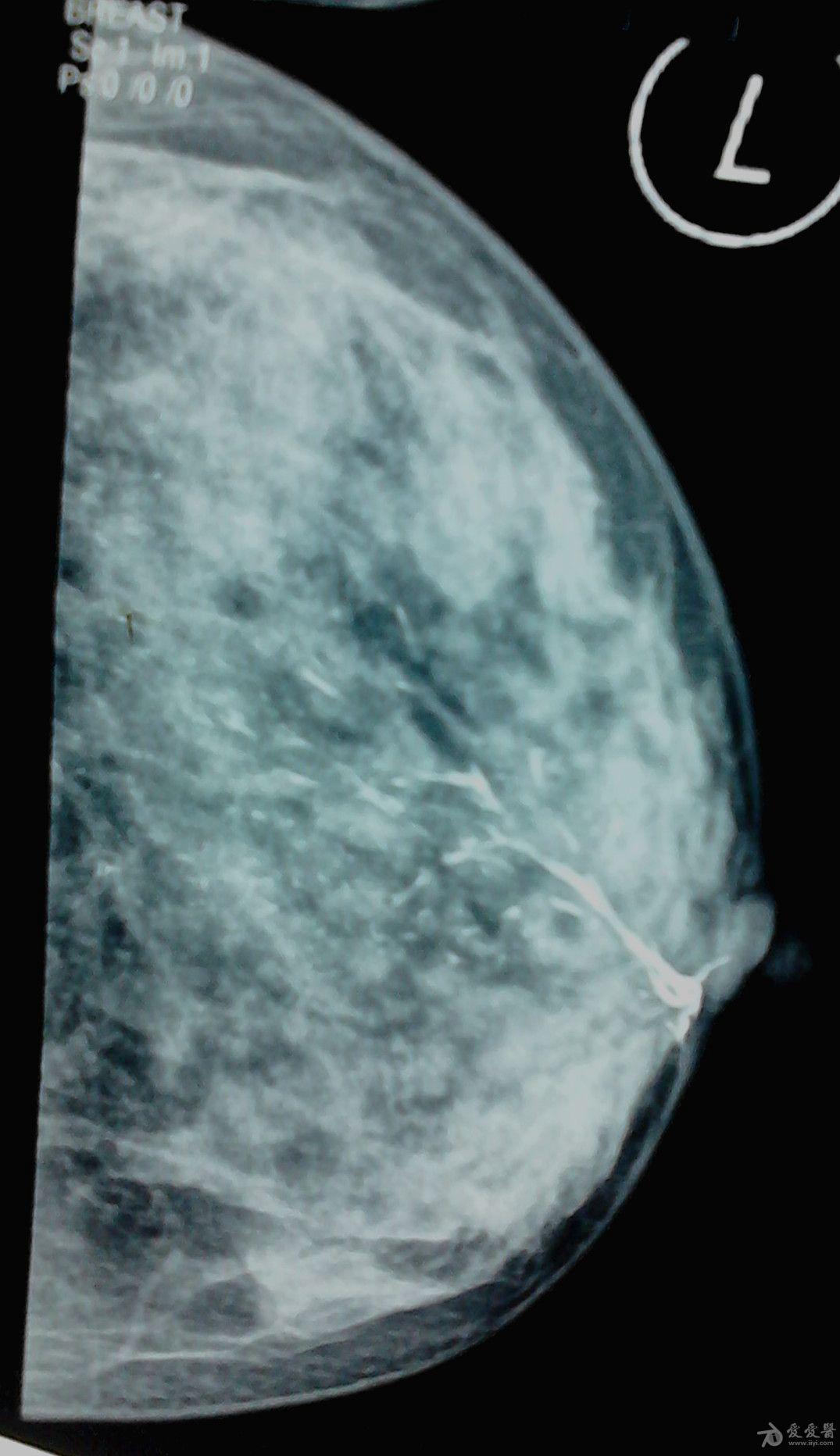 乳腺导管造影图片