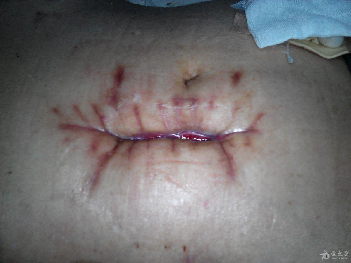 侧切伤口脂肪液化图片图片