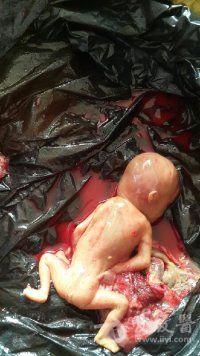 12周引产出来胎儿图片图片