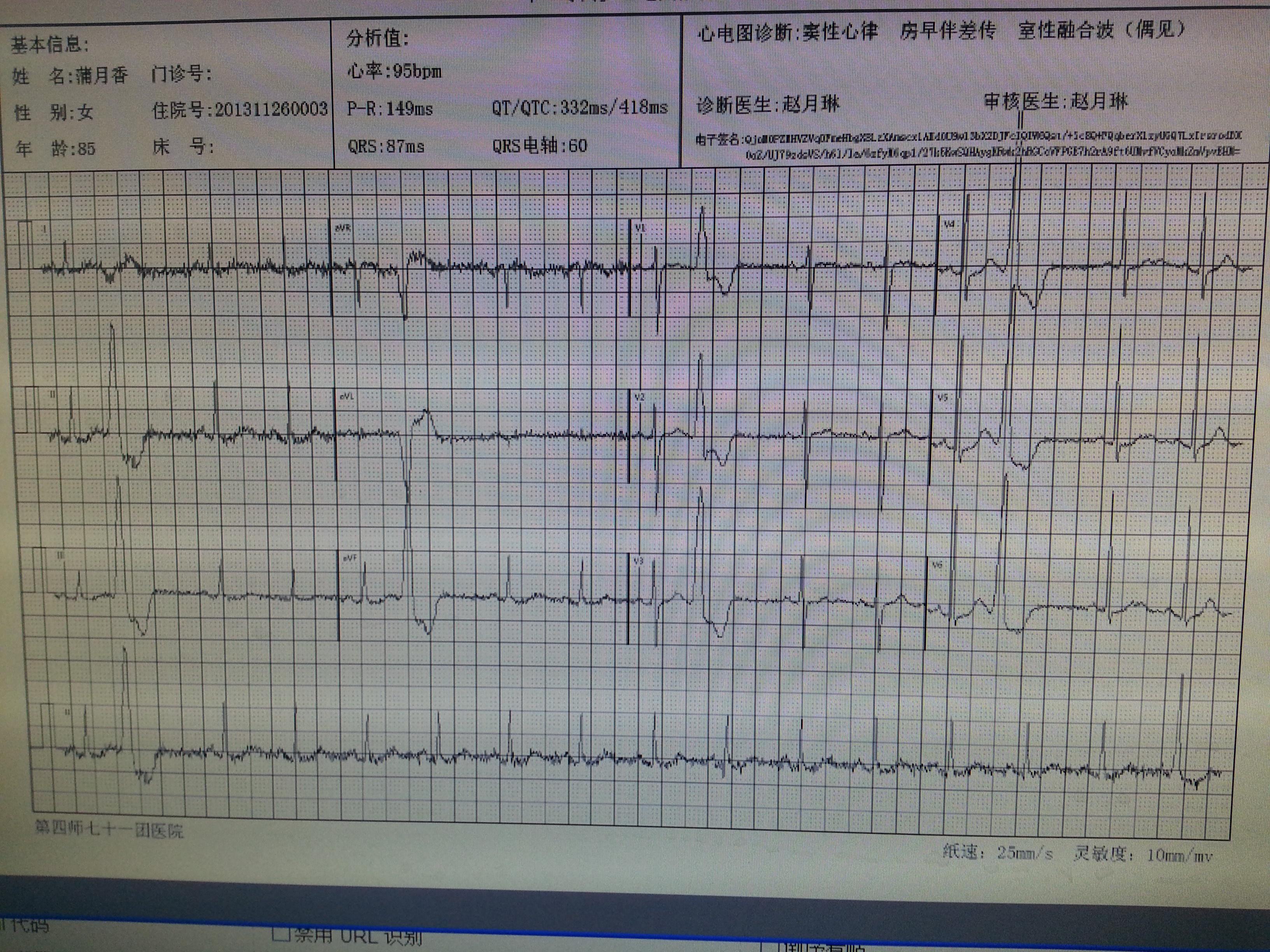 是房早伴差傳還是室早,請各位老師指教 - 心電圖腦電圖專業討論版