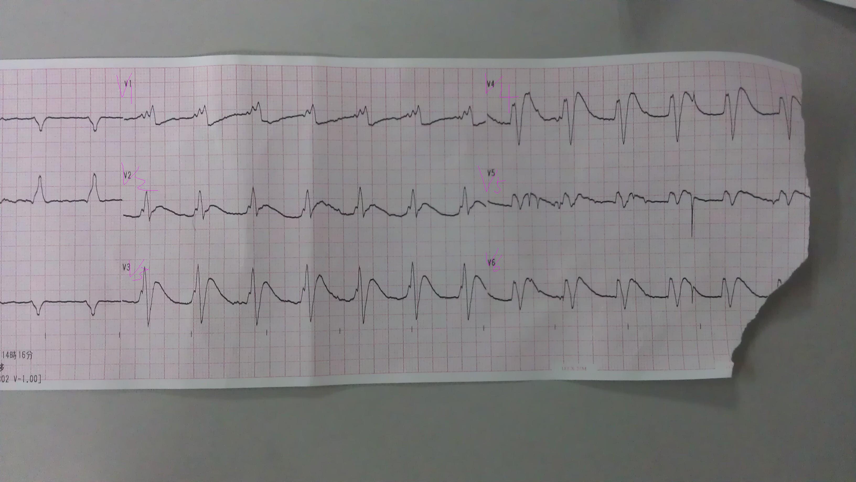请山羊老师trg老师及各位老师帮忙看看起搏器心电图急急急