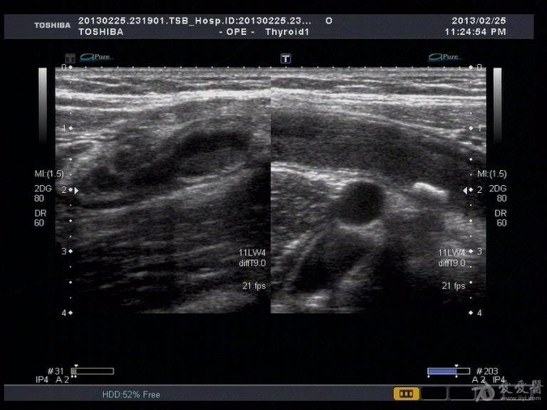 典型阑尾脓肿一例 - 超声医学讨论版 - 爱爱医医学论坛