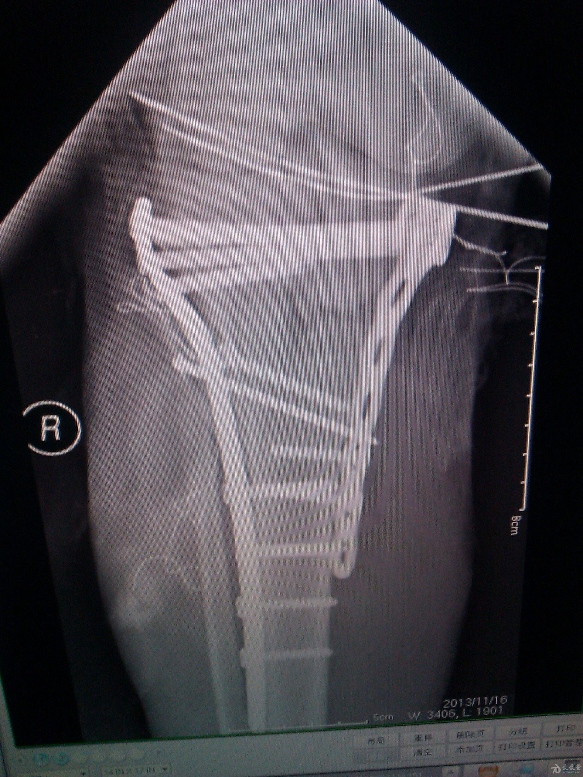 骨折钢板伤残图片