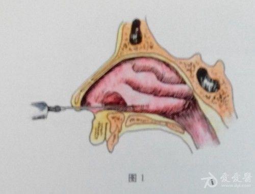 耳鼻咽喉头颈外科手术征集——下鼻甲部分切除术