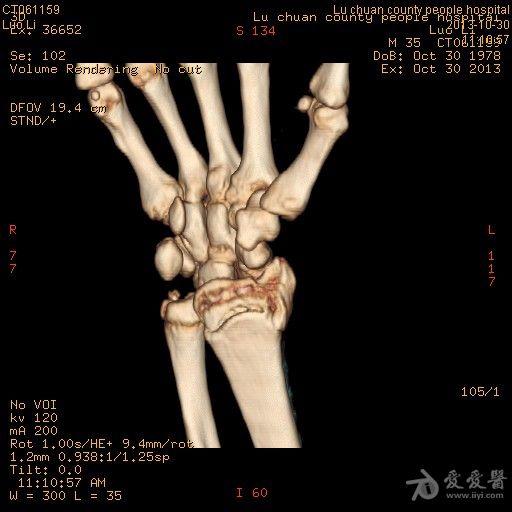 橈骨遠端陳舊性骨折一例