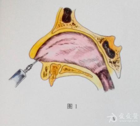 鼻中隔三线减张矫正术图片