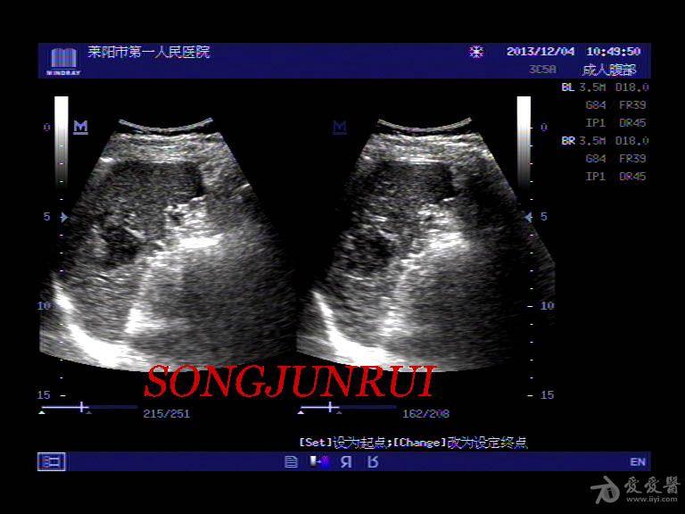 超声入门贴305脾破裂