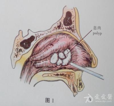 耳鼻咽喉头颈外科手术征集——鼻息肉摘除术