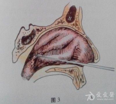 耳鼻咽喉头颈外科手术征集——鼻息肉摘除术