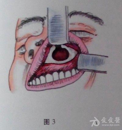 耳鼻咽喉頭頸外科手術徵集——上頜竇入路篩竇開放切除術