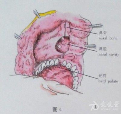 耳鼻咽喉头颈外科手术征集——上颌骨全切除术