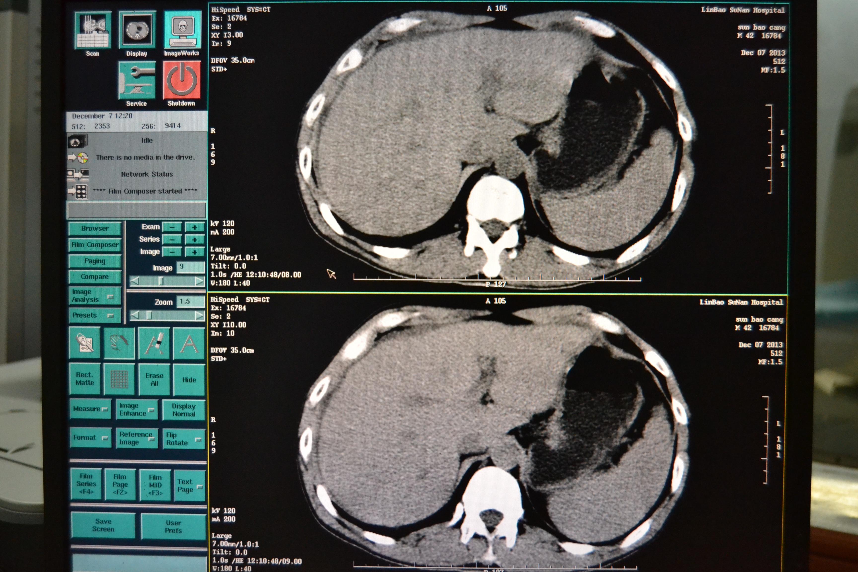 上腹部正常的CT图片图片