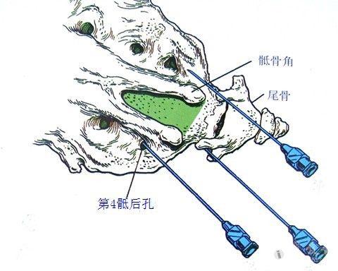 骶管麻醉的标志图片