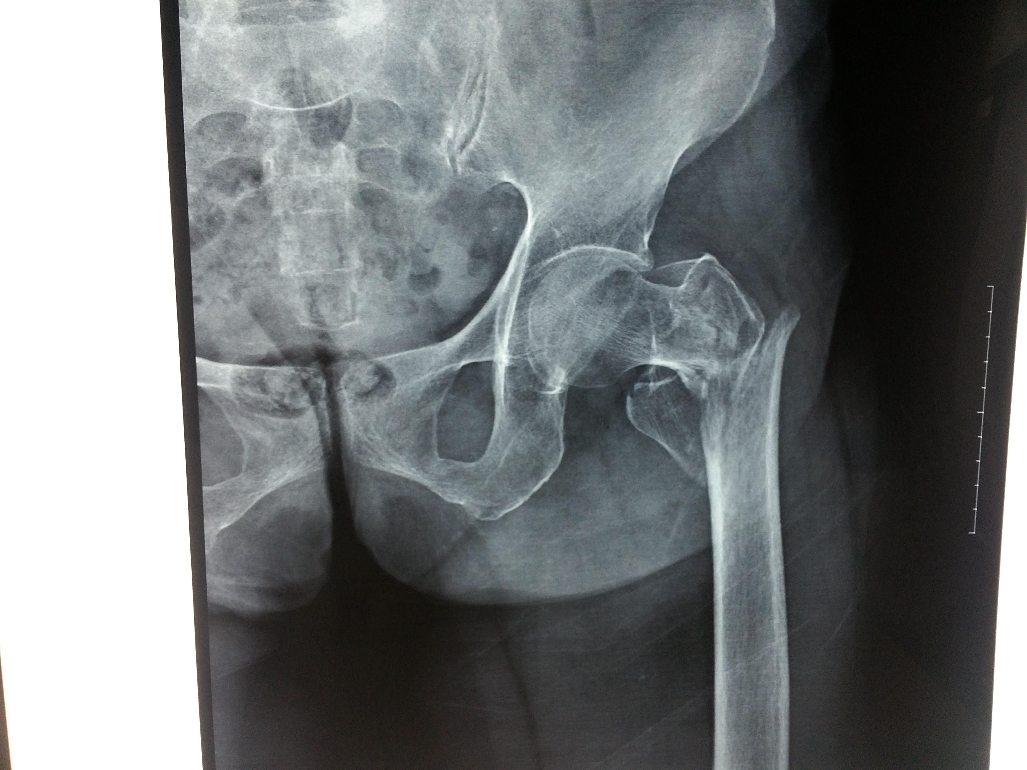 该例股骨粗隆间骨折该选取什么样的手术方式
