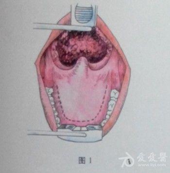 耳鼻咽喉头颈外科手术征集鼻咽癌切除术