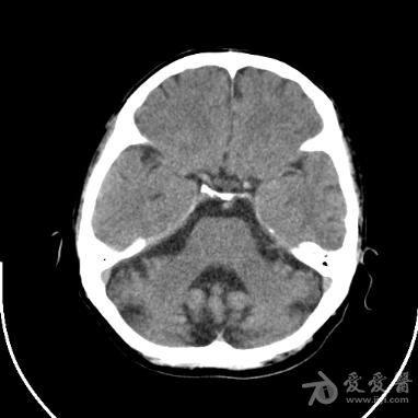 小脑萎缩ct图片
