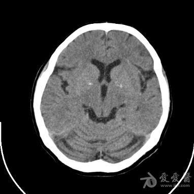 小脑萎缩ct图片
