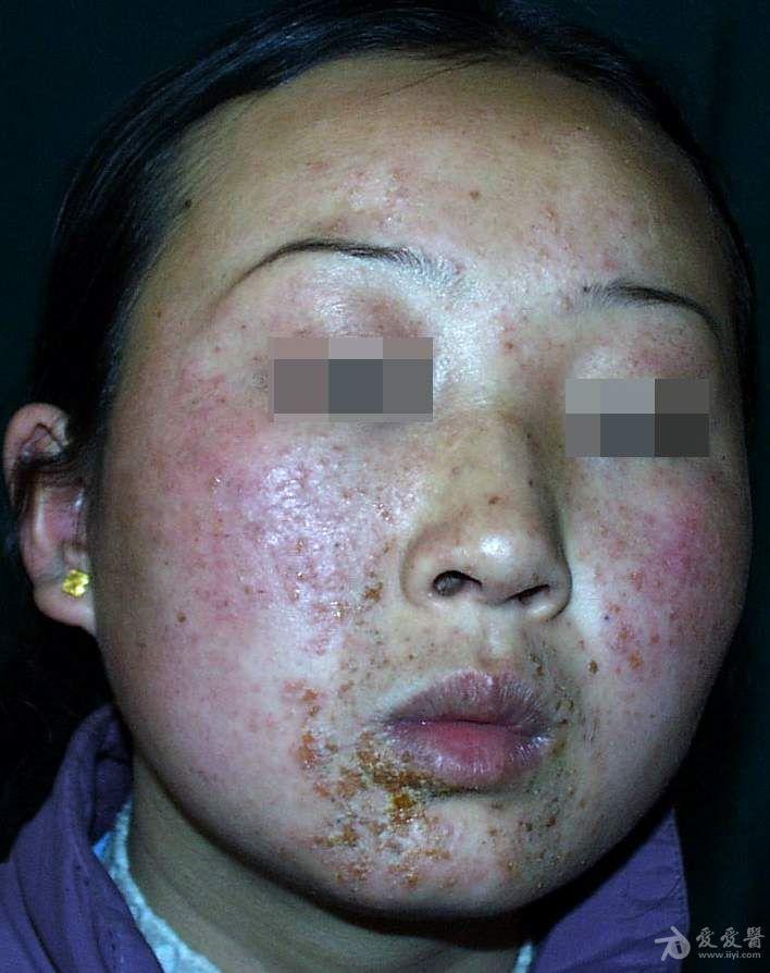 脸上感染金葡菌的图片图片