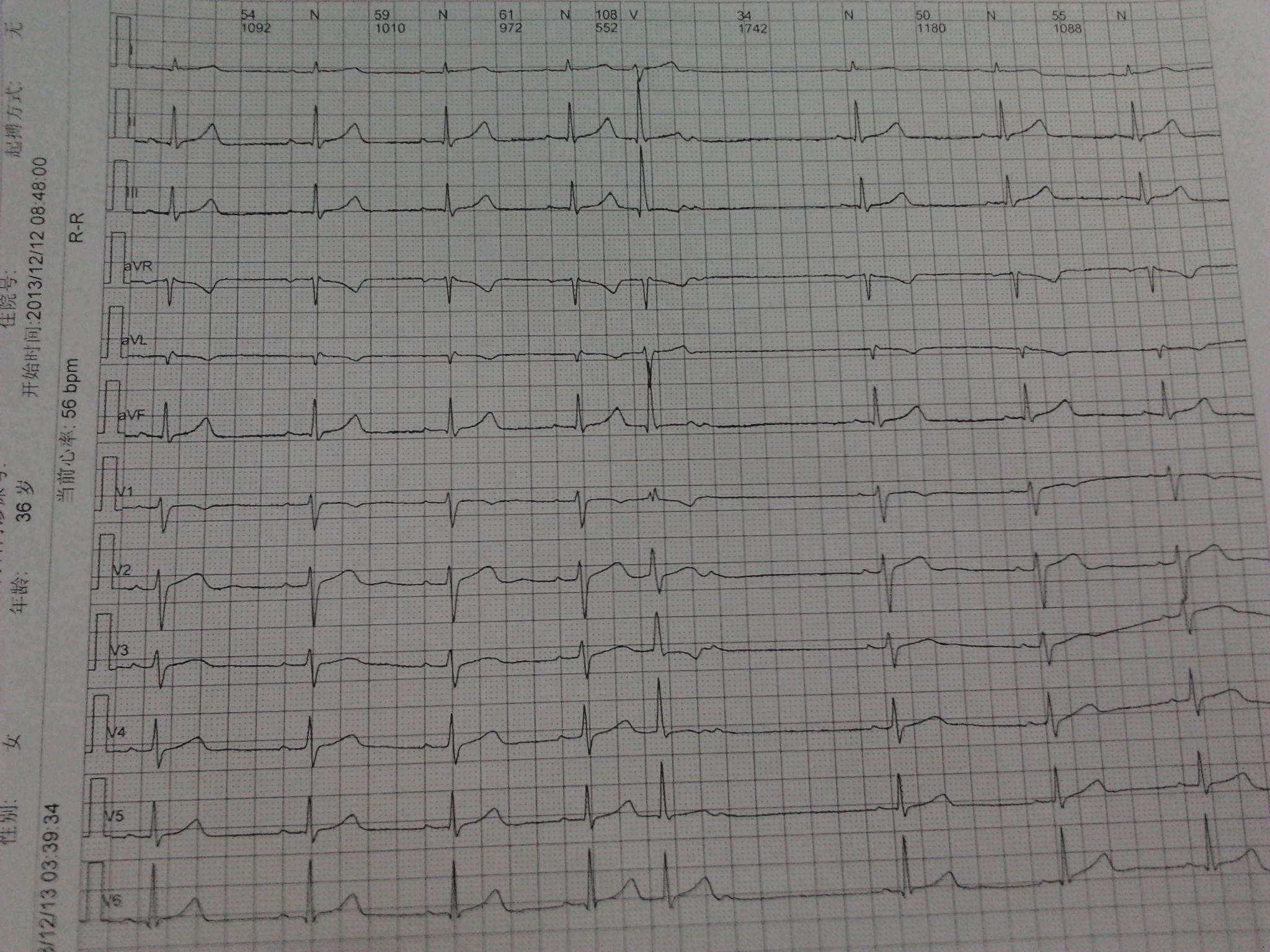 请教各位老师间位性室性早搏后貌似有个p波后脱落
