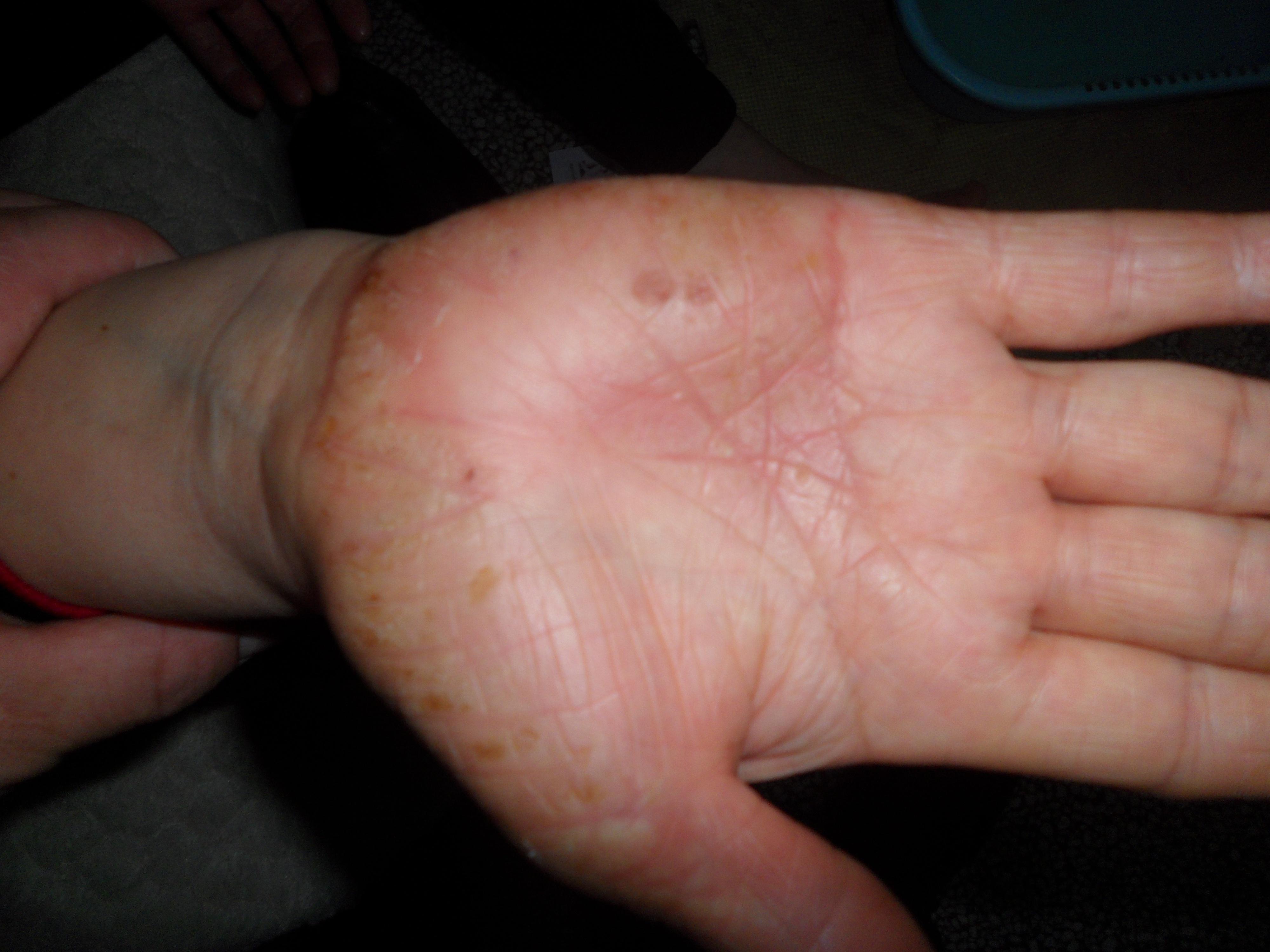 这是慢性手足湿疹吗