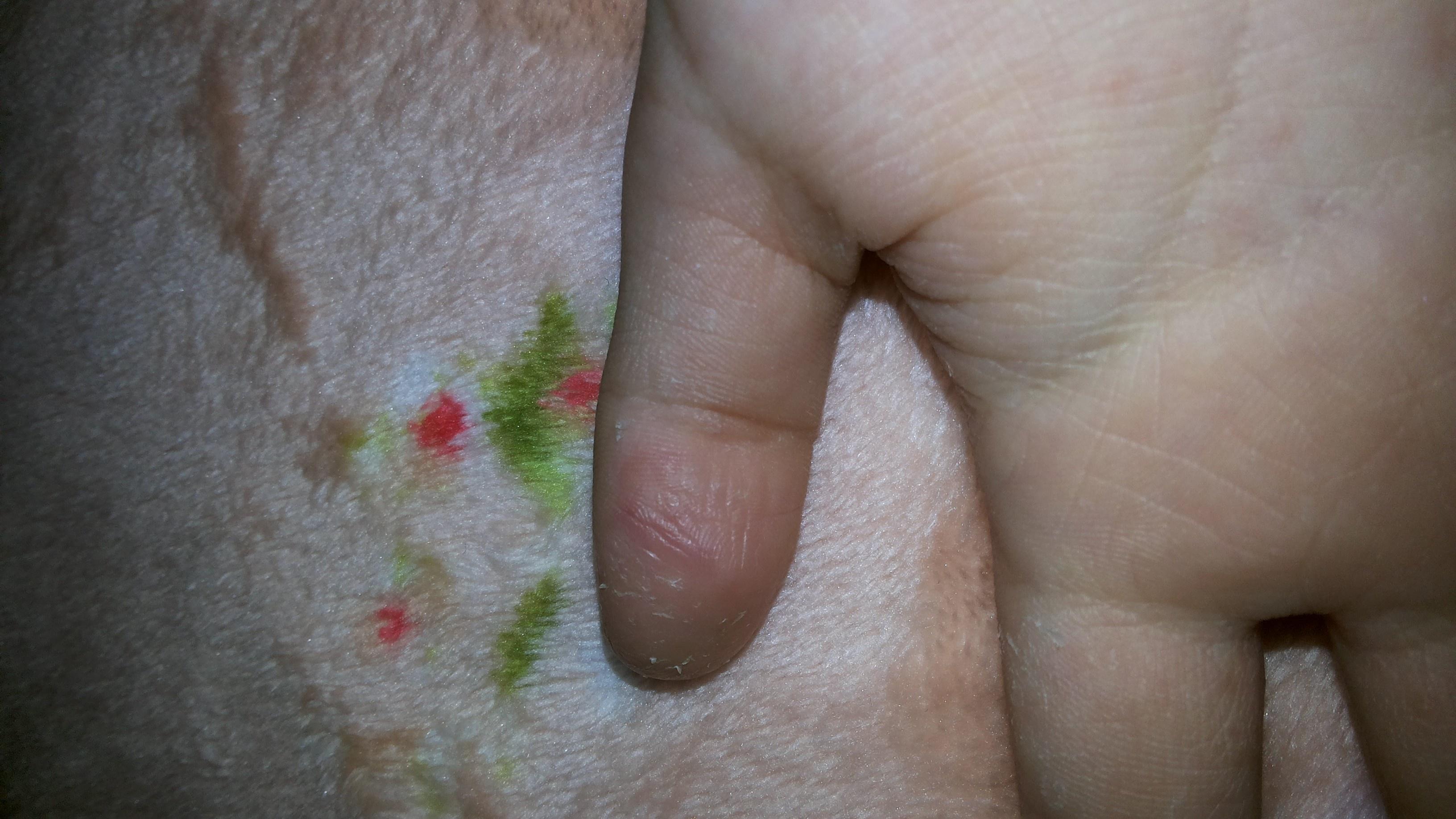 儿童手指皮肤角质化图片