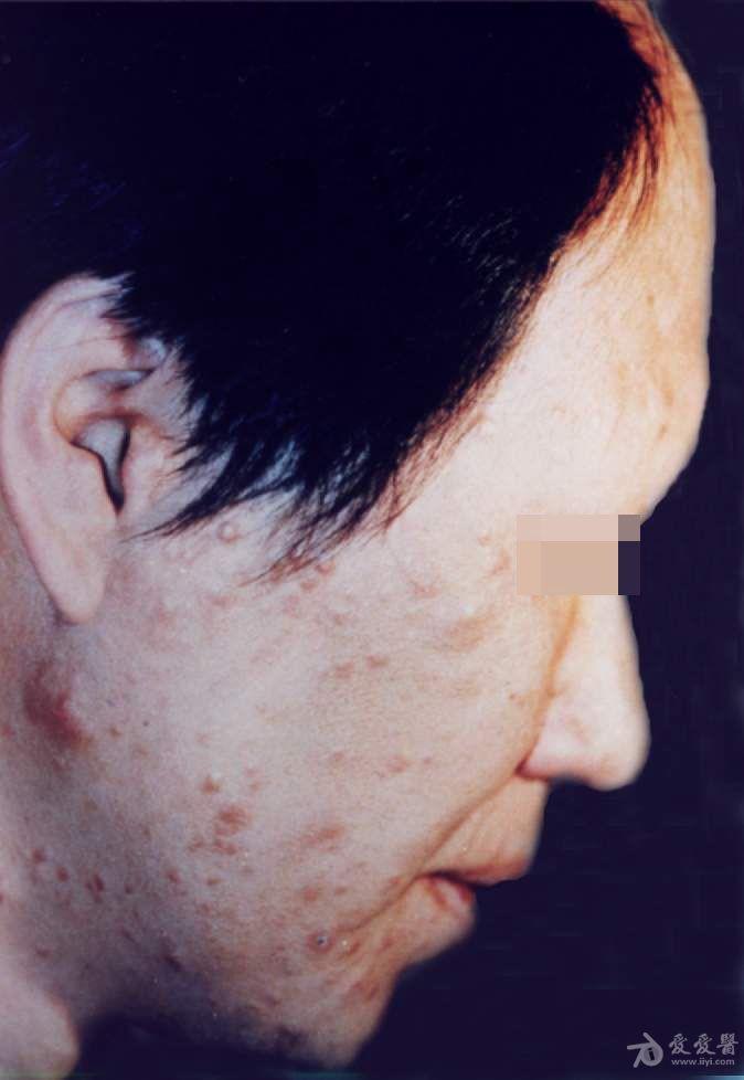 皮肤性病图谱☆有☆奖☆点☆评☆33:麻风.