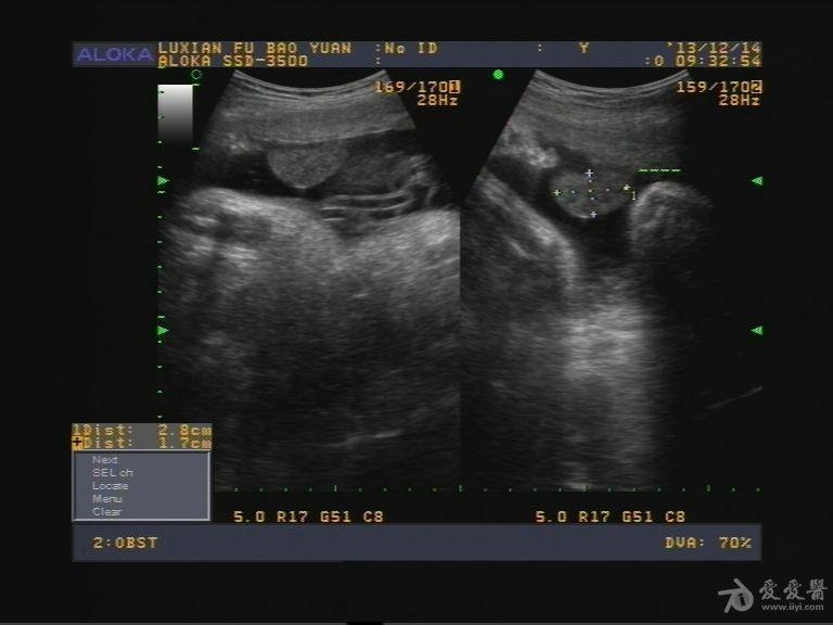 请大家帮忙看看这是羊膜片吗