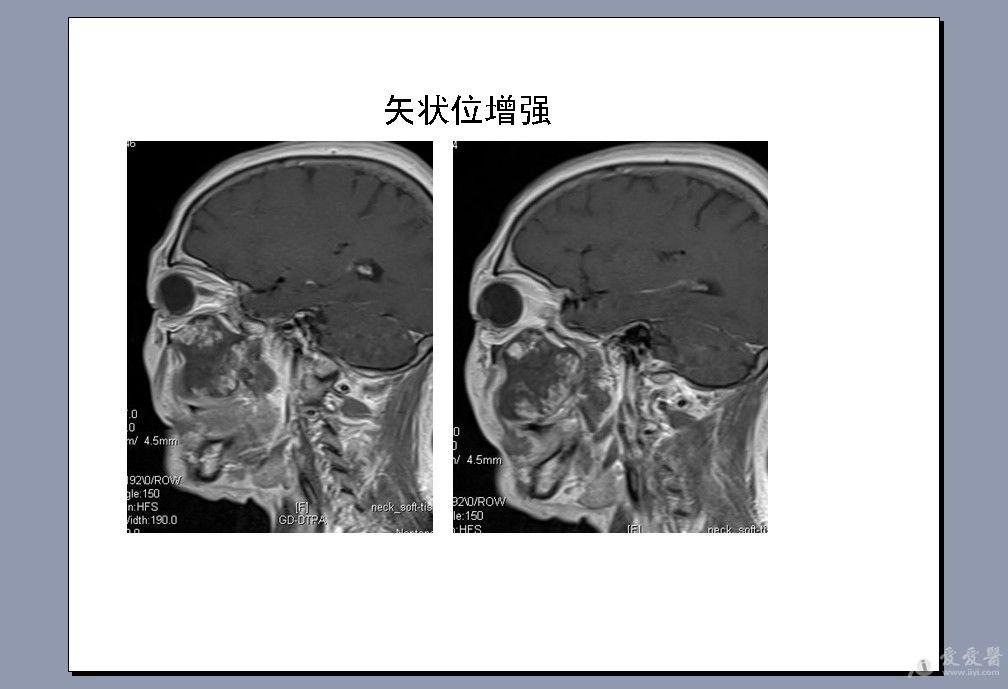 女65岁左侧颌面部病变ct及mri检查