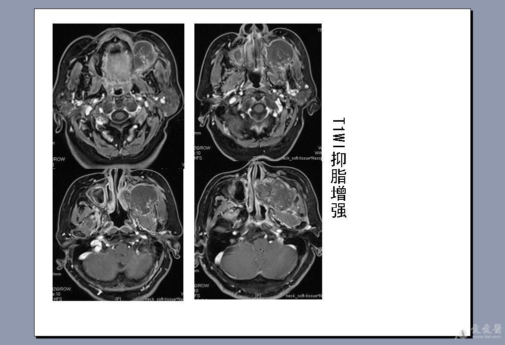 女65岁左侧颌面部病变ct及mri检查