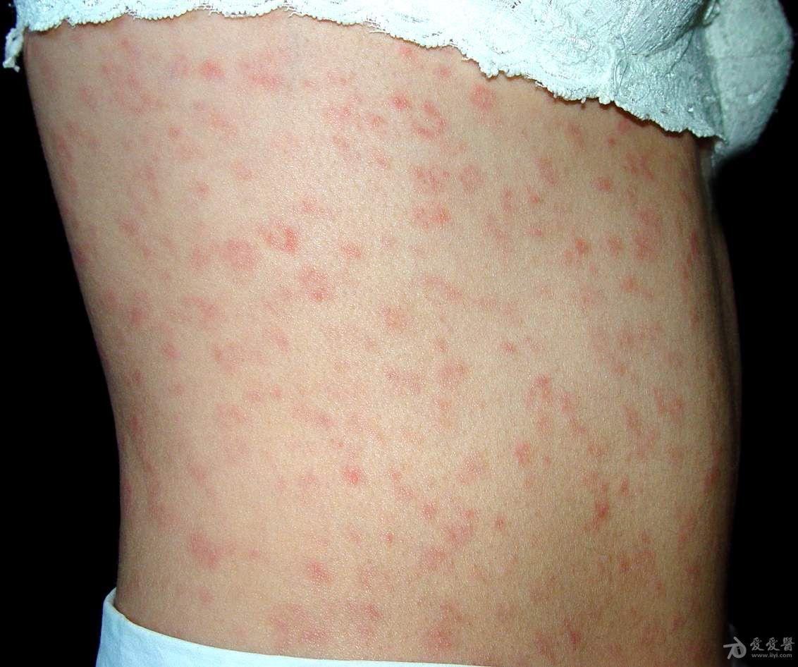 女性梅毒疹症状图片图片