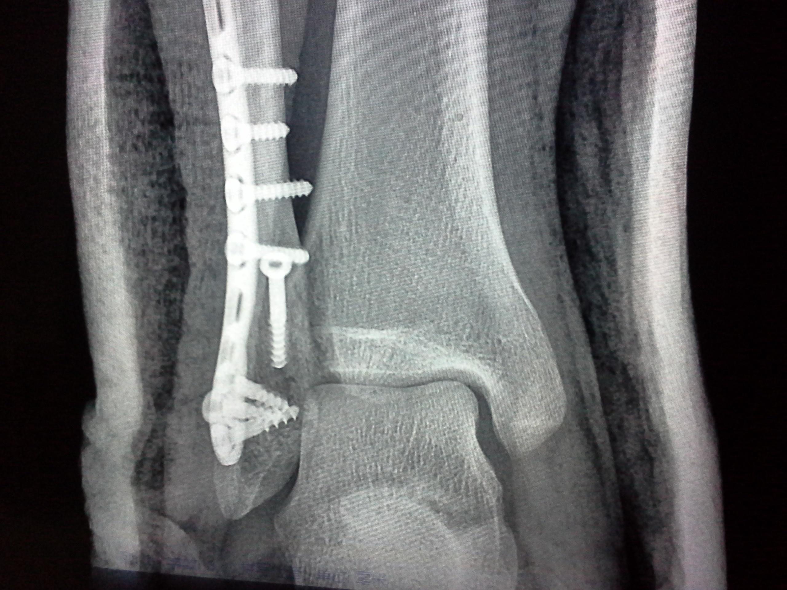 右外踝及后踝骨折一个月复查