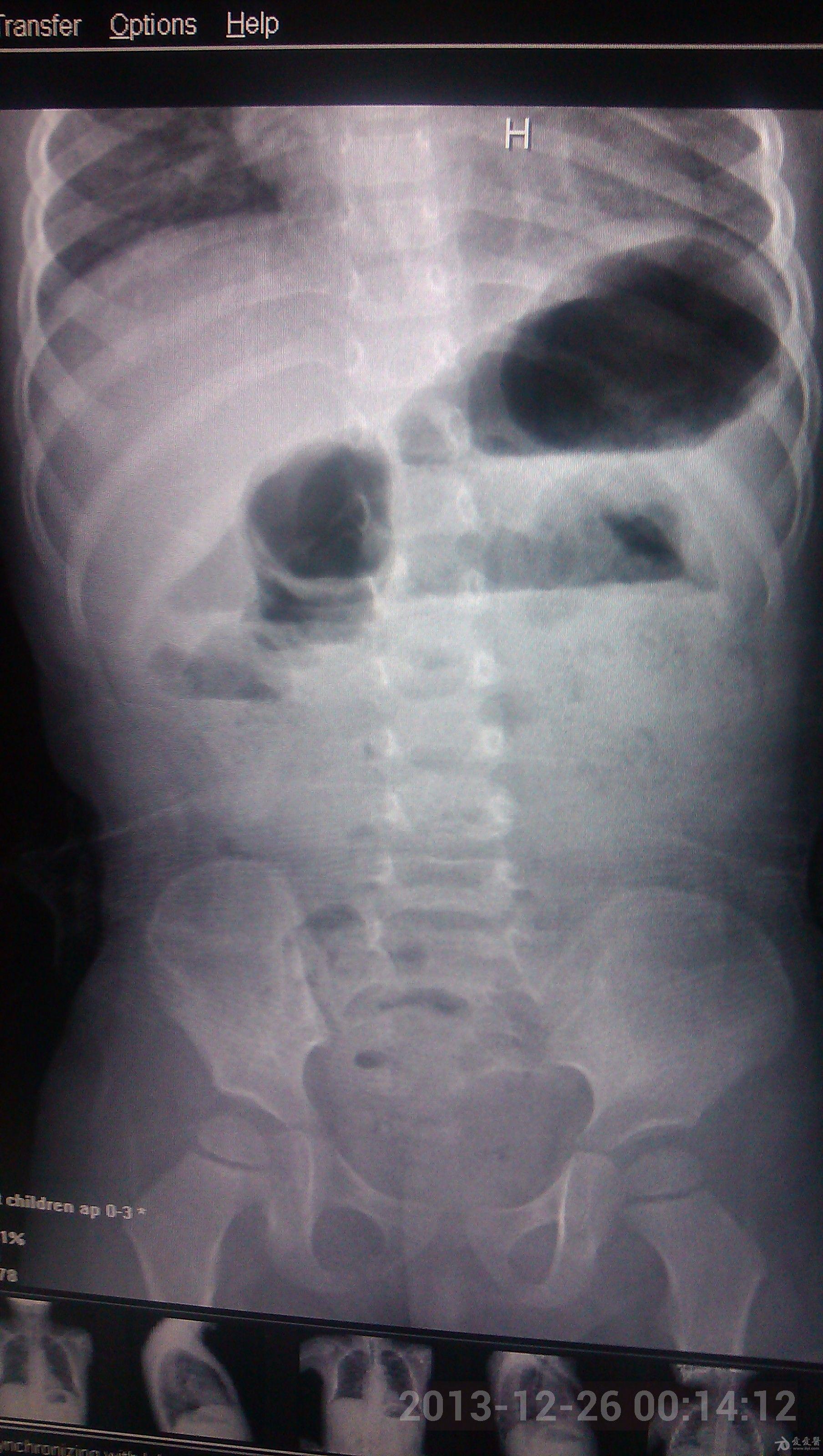 怀疑小儿急腹症求助